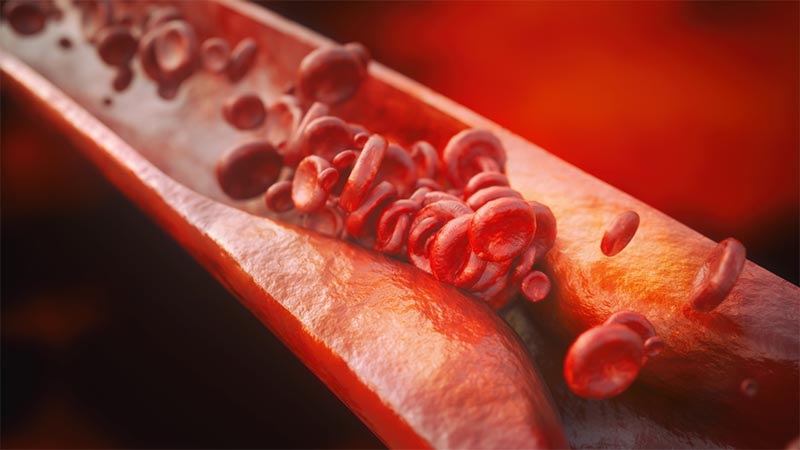 Closeup of a atherosclerosis with high details - 3D rendering